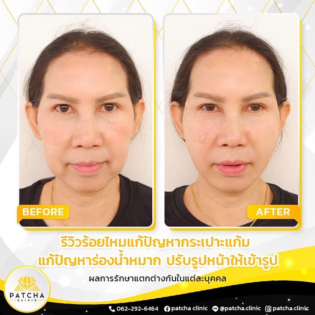 รีวิวร้อยไหมยกกระชับกรอบหน้าที่ PATCHA CLINIC