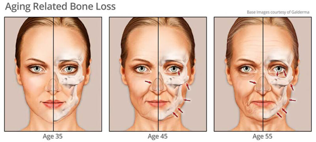 Aging Relates Bone Loss เมื่อมนุษย์อายุมากขึ้นจะเริ่มสูญเสียมวลกระดูกหรือที่เรียกว่า Bone Resorption